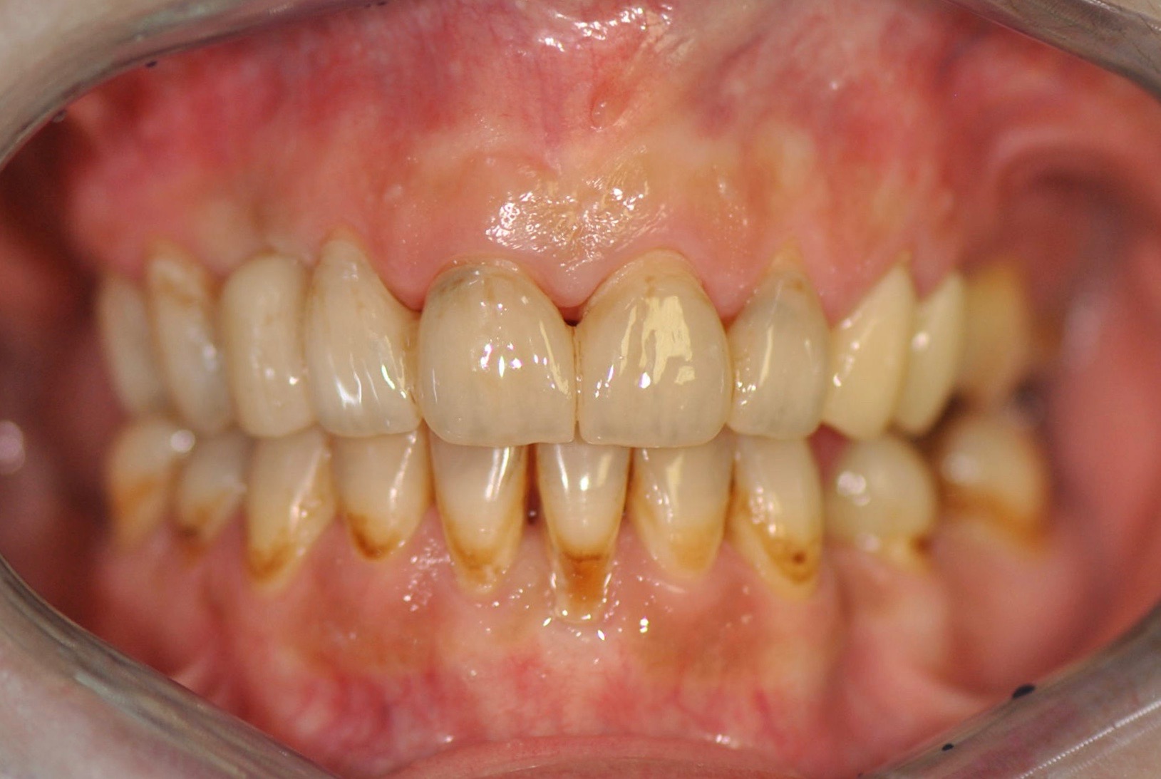 grafen-zubni-nahrada