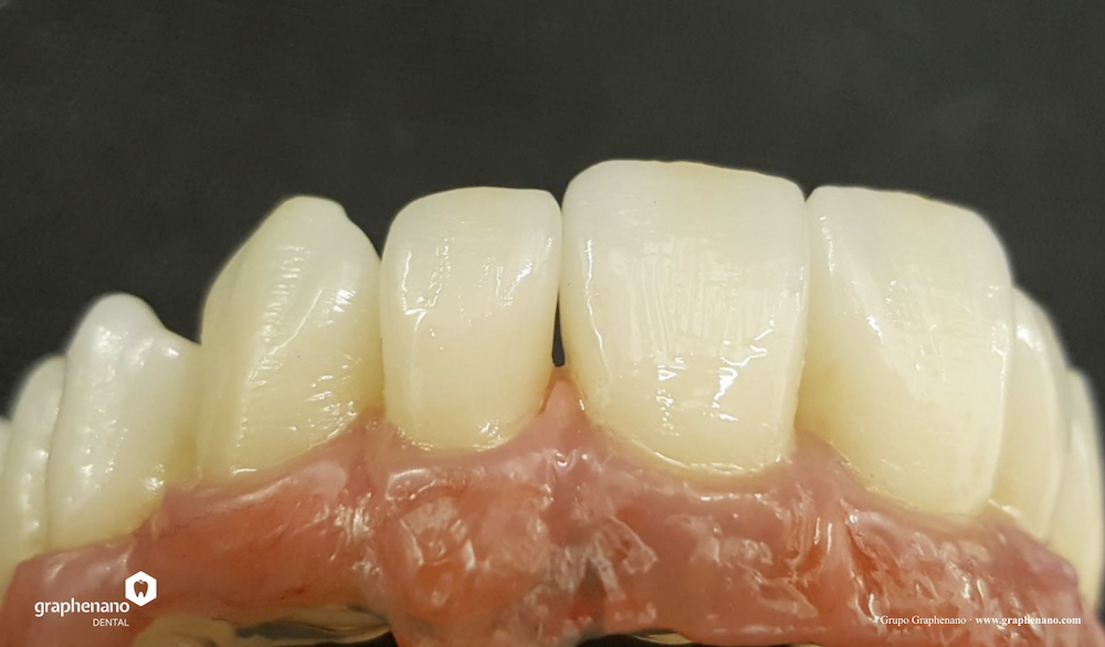 zubni-nahrada-grafen