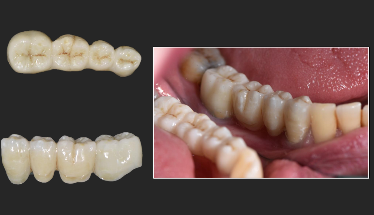 distal-mustek-z-grafenu