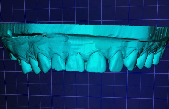 wax-up-CAD