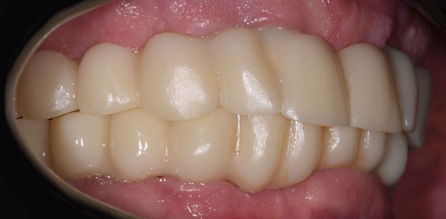 wax-up-pmma-jslab