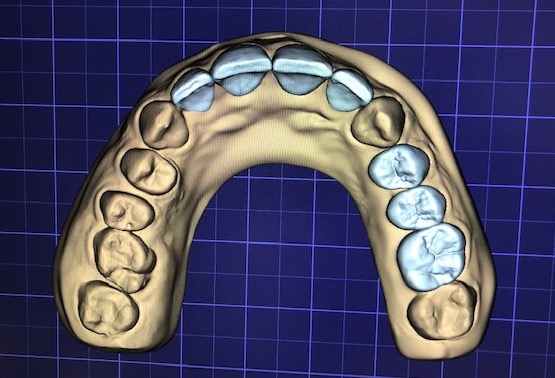 wax-up-CAD-jslab