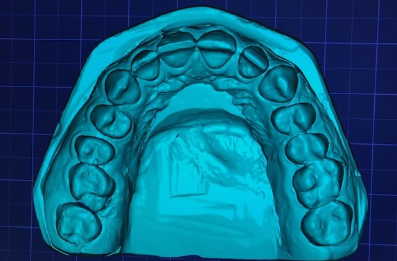 wax-up-CAD-jslab