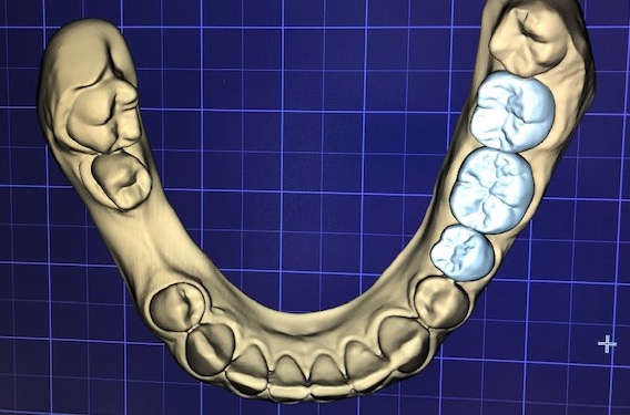 wax-up-CAD-jslab