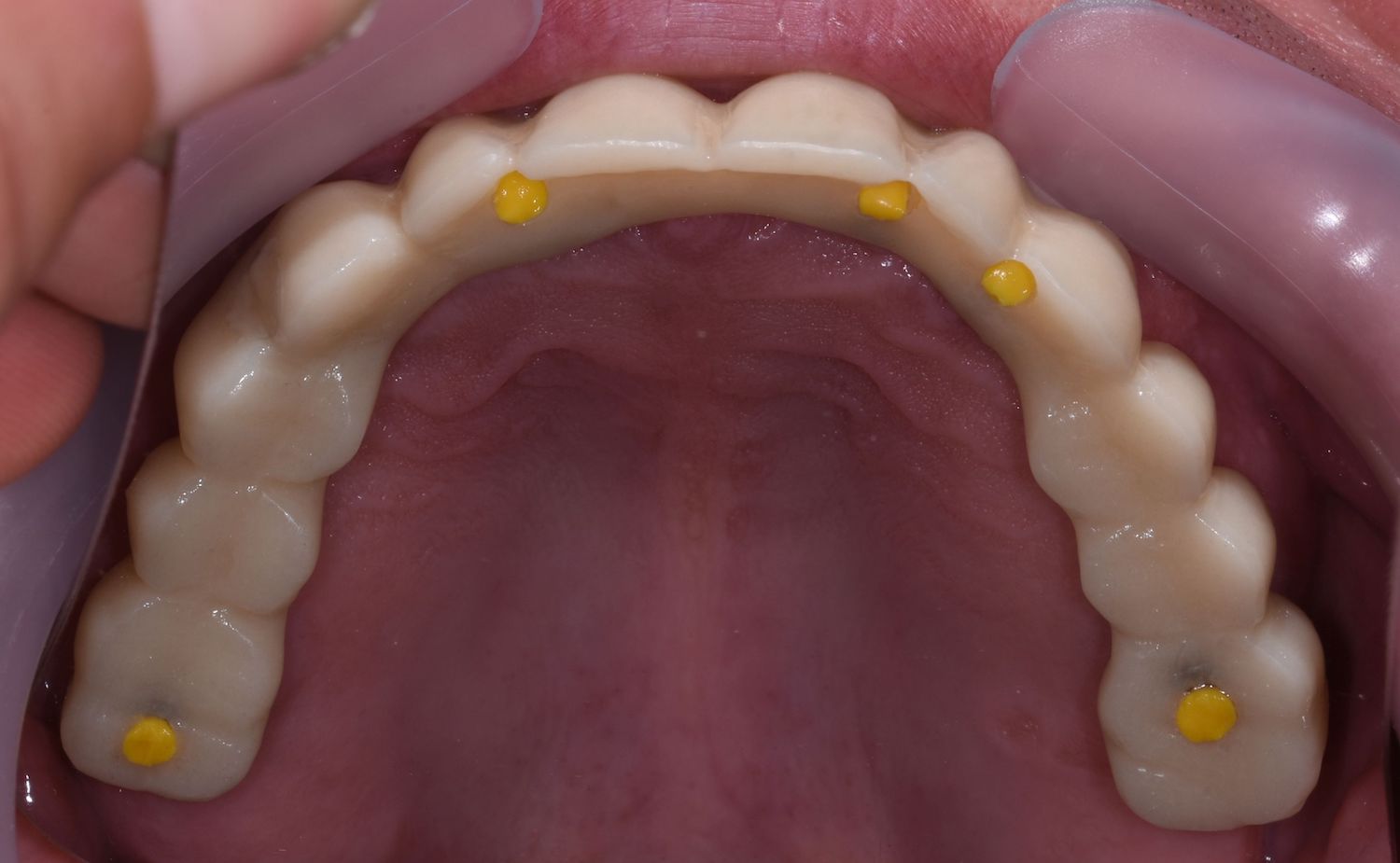 wax-up-pmma-jslab