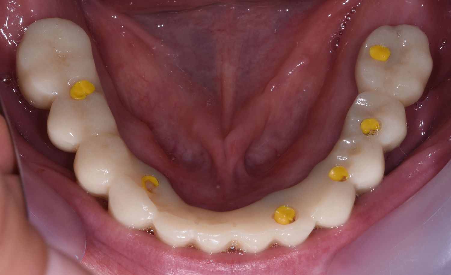 wax-up-pmma-jslab