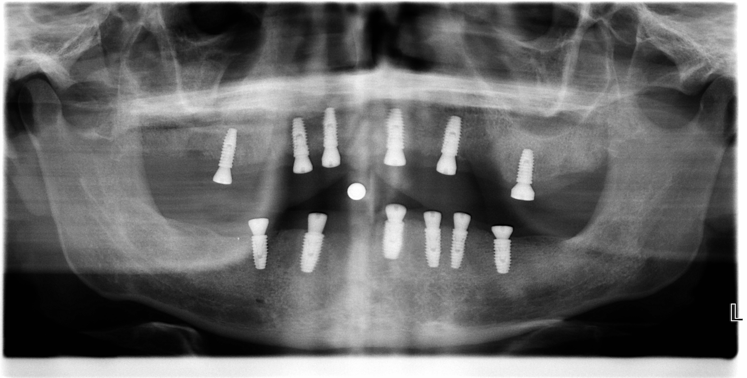 wax-up-pmma-jslab